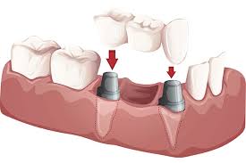 dental-implant-picture