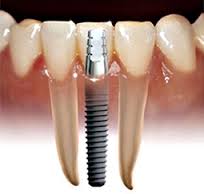 front-tooth-implant